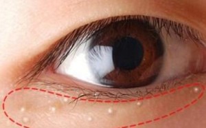 脸上长脂肪粒怎么办 消除脂肪粒的方法