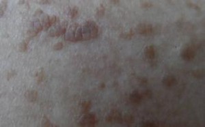 扁皮尤是怎么引起的 消除扁皮尤的方法 扁皮尤是怎么引起的 消除扁皮尤的方法