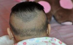 宝宝有枕秃是缺钙吗?宝宝枕秃该怎么办? 宝宝有枕秃是缺钙吗?宝宝枕秃该怎么办?