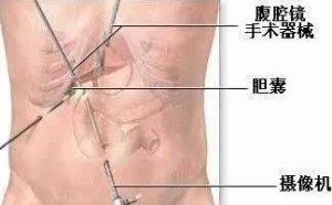 腹腔镜微创手术多少钱 腹腔镜手术怎么做的？
