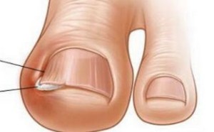 甲沟炎怎么治疗 治疗甲沟炎的最佳方法