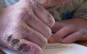 引起冻伤的主要原因及治疗方法