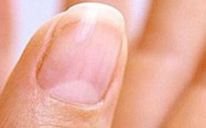 林赛氏指甲就一定是慢性肾衰竭吗？