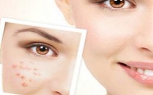 脸上各部位长痘痘的原因分析