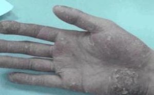 手掌心脱皮是什么原因，用什么药膏治疗？