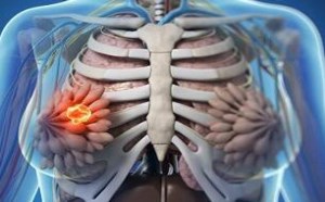 乳腺癌的早期症状有哪些