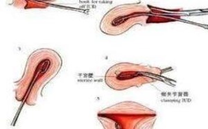 取环是怎么取的?取环手术全过程图片 取环是怎么取的?取环手术全过程图片