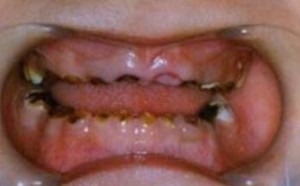 龋齿为什么在早期不容易被发现 龋齿为什么在早期不容易被发现