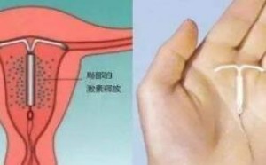 做取环手术费要多少钱 取环手术全过程介绍