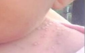 脖子上长小肉粒疙瘩是什么原因 脖子上长小肉粒疙瘩是什么原因