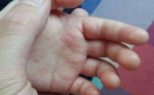 手上起小水泡痒怎么办用什么药治疗 手上起小水泡痒怎么办用什么药治疗