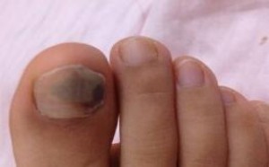 灰指甲怎么治疗_灰指甲的治疗方法有哪些 灰指甲怎么治疗_灰指甲的治疗方法有哪些