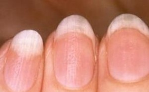 指甲上有竖纹是怎么回事，怎么调理？