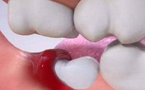 智齿一定要拔吗 怎么判断智齿要不要拔 智齿一定要拔吗 怎么判断智齿要不要拔