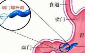 如何根除幽门螺杆菌 幽门螺杆菌根治方法 如何根除幽门螺杆菌 幽门螺杆菌根治方法