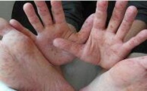 手足口病第几天最严重 手足口病的发病规律 手足口病第几天最严重 手足口病的发病规律