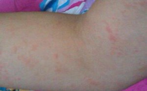 手臂上有很多小红点怎么回事原因及治疗方法