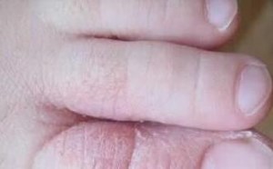 脚气怎么根治 最好不再复发的偏方 脚气怎么根治 最好不再复发的偏方