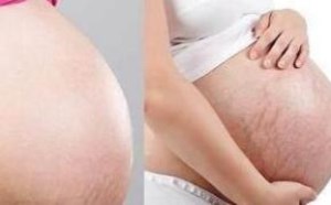 孕妇做到这3点 再也不怕妊娠纹找上门