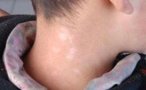 白癜风早期症状有哪些