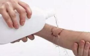 被动物咬了有必要打狂犬疫苗吗？狂犬疫苗多少钱