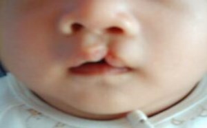 兔唇是什么原因造成的 怎样预防胎儿兔唇