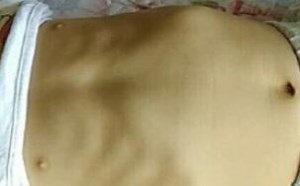 宝宝肋骨外翻怎么回事 出现肋骨外翻怎么办 宝宝肋骨外翻怎么回事 出现肋骨外翻怎么办