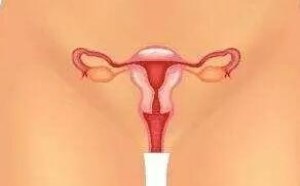 子宫切除对女性身体有什么影响 子宫切除对女性身体有什么影响