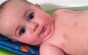 湿疹会传染吗 有哪些禁忌 湿疹会传染吗 有哪些禁忌