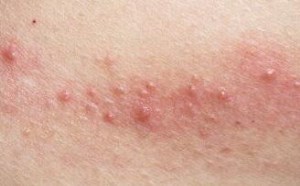 接触性皮炎怎样治疗