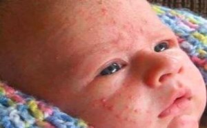 宝宝湿疹怎么治疗