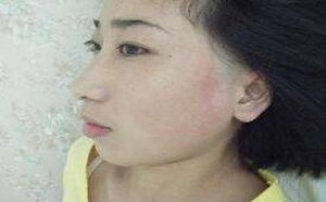 白电风能治好吗？如何治疗白癜风