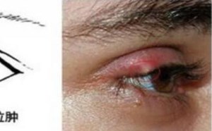 眼睛长了麦粒肿怎么办
