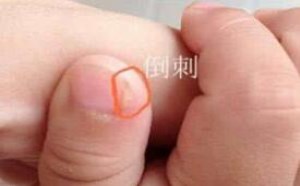 宝宝手上有倒刺怎么办？正确护理相当重要