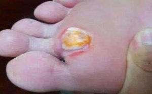 鸡眼怎么治能断根偏方 鸡眼怎么治能断根偏方