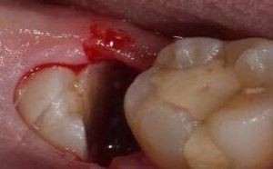 拔智齿后悔死了患上干槽症