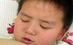 怎么知道是不是长水痘 水痘刚开始的样子图片