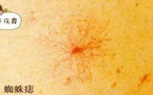 蜘蛛痣有哪些影响 怎么治疗?