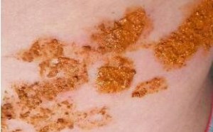 带状疱疹传染吗？饮食上有哪些禁忌