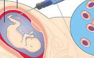 羊水穿刺疼吗 羊水穿刺最佳检查时间