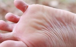 脚底长水泡发痒怎么办？脚底长水泡的治疗方法