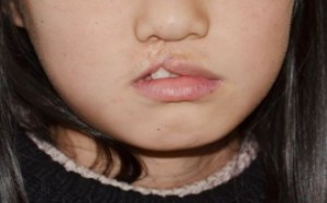 唇腭裂是怎么造成的原因是什么