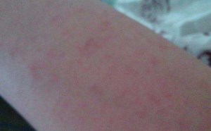 身上长红点是什么原因该怎么办